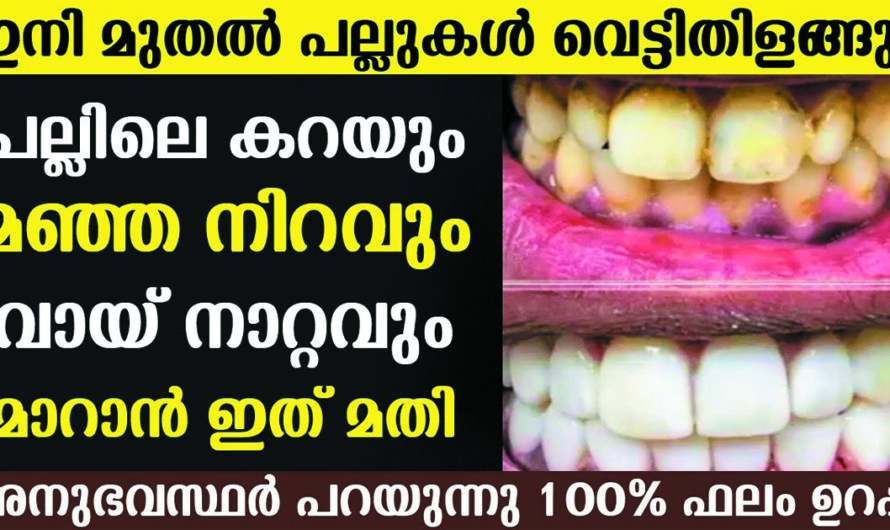 പല്ലിലെ കറയും മഞ്ഞ നിറവും വായ് നാറ്റവും മാറി പല്ലുകൾ തിളങ്ങും